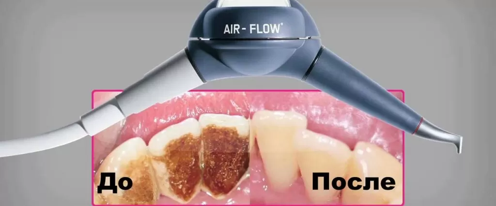 Что такое Air Flow - что есть в арсенале у стоматолога для чистки зубного камня